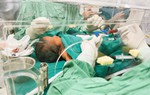 Bị vàng da, bé 3 ngày tuổi phải thay máu toàn phần