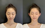 Bình luận trái chiều về trào lưu thẩm mỹ "tai yêu tinh"