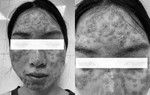 "Detox" da tại spa, cô gái bị bội nhiễm da Eczema herpeticum