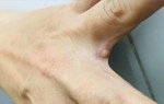Vết mụn nước ở ca mắc đậu mùa khỉ tại Việt Nam có nguy hiểm? Chuyên gia người Việt tại Đức lý giải