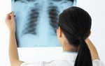 Phát hiện trên 76.000 người mắc bệnh lao