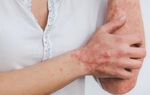 4 sai lầm thường gặp trong quá trình điều trị vảy nến khiến bệnh trầm trọng hơn