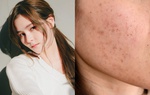Trị nám, tàn nhang tại nhà không hề khó