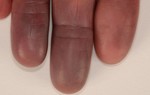 Hội chứng Raynaud khiến tay bị tím tái, đau buốt vào mùa đông
