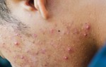 Vị trí mọc mụn trứng cá cảnh báo gì về sức khỏe của bạn?
