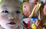 Mẹ ám ảnh vì con nổi mẩn khắp mặt, tự cào đến chảy máu vì bị dị ứng đạm sữa bò