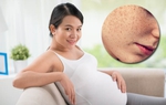 Bác sĩ da liễu chia sẻ kiến thức quan trọng về nám da khi mang thai