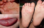 Trẻ bị chân tay miệng nên tắm lá gì?