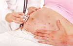 Những điều bà bầu lưu ý nếu mắc sốt xuất huyết 