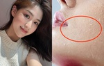 Vì sao mùa đông vẫn cần bôi kem chống nắng đầy đủ? 