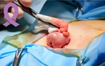 Tìm hiểu về bệnh ung thư đại tràng giai đoạn 1