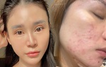 5 sản phẩm phải có khi dùng BHA để skincare