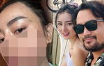 Hotgirl miền Tây nâng cơ mặt, bị kích ứng bỏng da