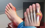 Điều cần biết về bệnh biến dạng khớp bàn ngón chân