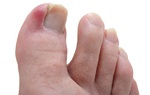 Ngón chân cái bị sưng đau mưng mủ do đâu?