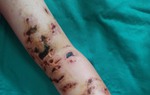 Bé 10 tuổi chằng chịt vết thương do bị sứa đốt