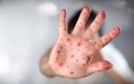 Chăm sóc trẻ bị tay chân miệng tại nhà: 5 việc quan trọng cần làm 