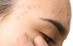 Mụn ở tuổi dậy thì có hết không? Cách xử lý mụn ở tuổi dậy thì