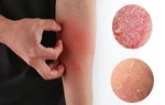 Cách giảm ngứa khi bị sốt xuất huyết