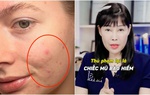 Thủ phạm gây nên mụn trứng cá, nguy hiểm cận kề chị em chẳng mấy bận tâm
