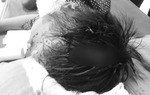 Bé 8 tuổi bị chó cắn đa chấn thương, lộ xương sọ