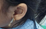 Từ vụ bé gái bị dị vật xuyên ống tai: Cách phát hiện và xử lý dị vật trong tai là gì?