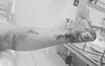 Bị hoại tử, phải cắt cụt chân do mắc đái tháo đường nhưng không điều trị
