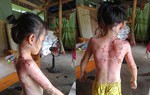 Ghen tuông, người phụ nữ tạt nước sôi khiến 2 cháu bé bỏng nặng