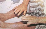Việt Nam đã có hướng dẫn điều trị bệnh đậu mùa khỉ