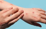 3 khuyến cáo để hạn chế nguy cơ mắc đậu mùa khỉ