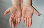 Nên cho trẻ ăn gì khi bị tay chân miệng và những lưu ý về chế độ dinh dưỡng 