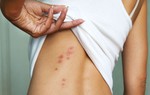 Cách xử lý khi bị côn trùng cắn, đốt vào mùa hè