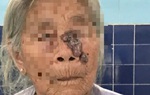 Từ nốt ruồi trên mặt, sau 3 tháng đi khám phát hiện ung thư da