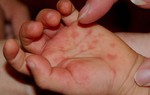 Bị chân tay miệng có phải kiêng gió không?