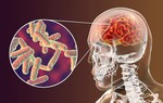 3 trường hợp tử vong do viêm não virus