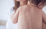 WHO công bố thông tin về bệnh đậu mùa khỉ