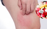 Dị ứng thuốc bao lâu thì khỏi? Có nguy hiểm không?