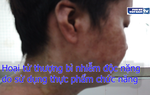 Hoại tử thượng bì nhiễm độc nặng do sử dụng thực phẩm chức năng