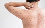 Xuất hiện dịch "cúm cà chua" rất dễ lây lan ở trẻ em tại Ấn Độ