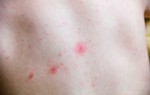 Da nổi chấm đỏ như nốt ruồi son không ngứa là bị làm sao?