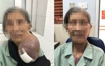 Cụ bà 40 năm đeo khối u khổng lồ trên cổ