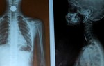 2 việc cần làm ngay khi trẻ bị hóc dị vật