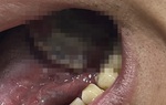 Tưởng nhiệt miệng, đi khám phát hiện ung thư lưỡi giai đoạn 4