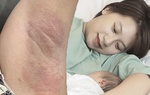 Thâm nách sau sinh, bà đẻ đi vi kim tảo biển nhận về cái kết muốn trầm cảm
