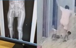 Hoàn cảnh gia đình bé trai bị mẹ đạp gãy xương đùi