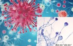 Nhiều người nhiễm nấm đen Mucormycosis, bệnh này nguy hiểm như thế nào?