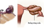 Nữ bệnh nhân 43 tuổi bị u buồng trứng xoắn 3 vòng