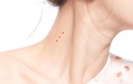 Cần đi khám ngay nếu thấy "nốt ruồi đỏ” xuất hiện bất thường