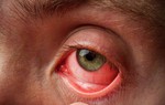 Cách phân biệt viêm kết mạc do virus, vi khuẩn và dị ứng vào mùa Xuân