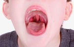 Phân biệt viêm họng thông thường và viêm họng liên cầu khuẩn